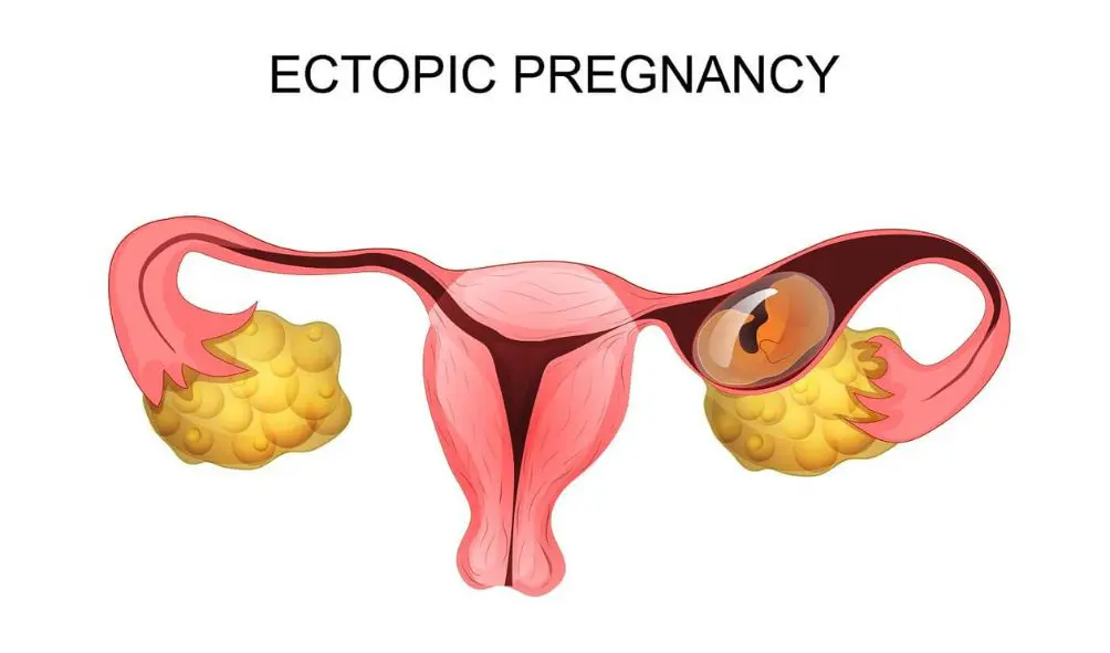 Ellsworth Plastic Surgery Fertility treatment options after an ectopic pregnancy