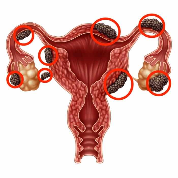 Endometriosis and fertility: Diagnosis, treatment, and management - Image