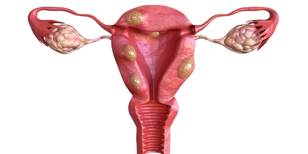 Ellsworth Plastic Surgery Fibroids and Fertility: Understanding the Connection and Treatment Options