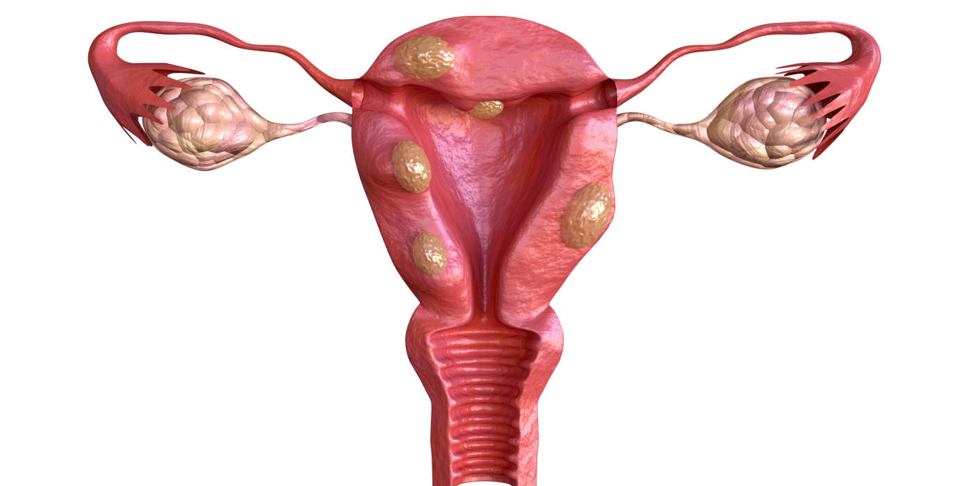 Fibroids and Fertility: Understanding the Connection and Treatment Options - Image