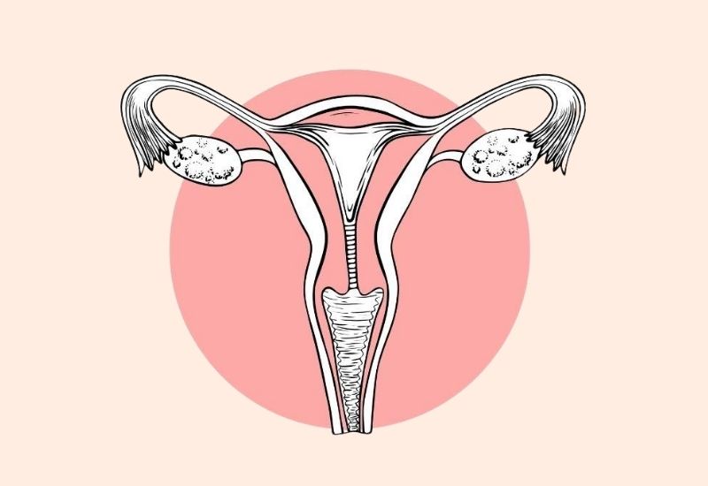 Inovi Fertility Ovarian hyperstimulation syndrome – Causes & risk factors